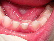 Adult Tooth Behind Baby Tooth - Pediatric and Cosmetic Dentists Keller, and Southlake TX - Donohue & Donohue, DDS