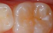 Tooth Before Sealant - Pediatric and Cosmetic Dentists Keller, and Southlake TX - Donohue & Donohue, DDS