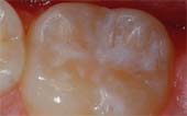 Tooth After Sealant - Pediatric and Cosmetic Dentists Keller, and Southlake TX - Donohue & Donohue, DDS