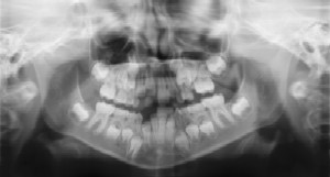 Dental Radiographs (X-Rays) - Pediatric and Cosmetic Dentists Keller, and Southlake TX - Donohue & Donohue, DDS
